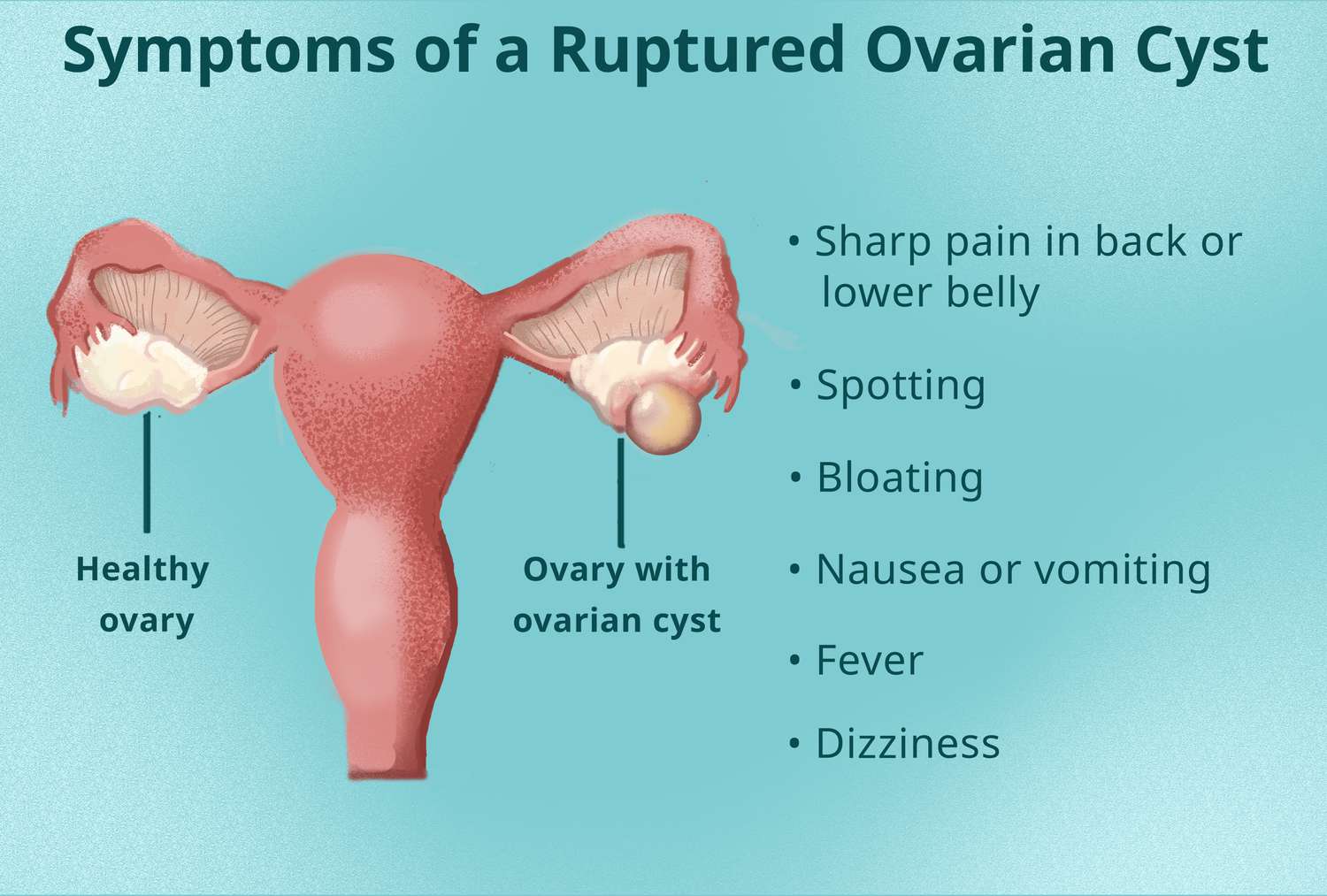 what does ovarian cyst pain feel like