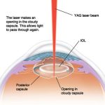 Precision the Power of YAG Laser yag laser