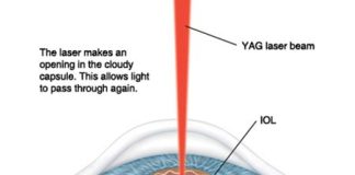 yag laser