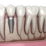 Remarkable Benefits of Dental Implants: A Game-Changer for Your Smile Dental Implants