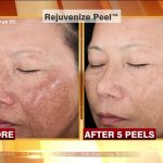 Reveal Your Radiance, Astonishing Benefits of Chemical Peel benefits of chemical peel
