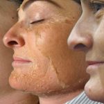 The Incredible Benefits of Chemical Peels, Radiant Skin benefits of chemical peels