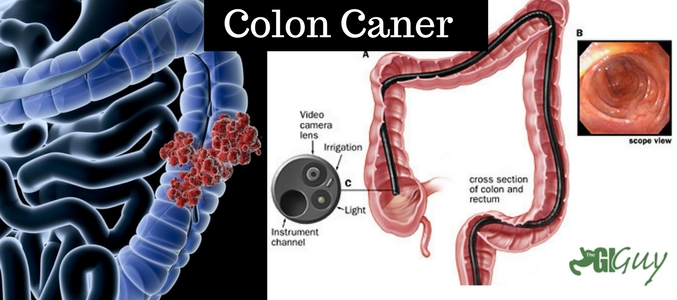 benefits of colonoscopy
