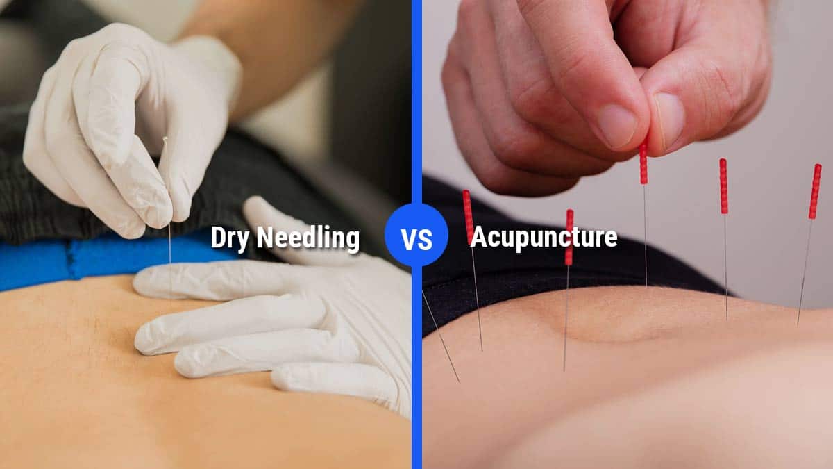 benefits of dry needling