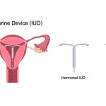 Benefits of IUD, Game-Changing Advantages of This Revolutionary Contraceptive Method benefits of iud