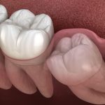 The Hidden Potentia, Astonishing Benefits of Keeping Wisdom Teeth benefits of keeping wisdom teeth