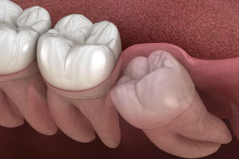 benefits of keeping wisdom teeth