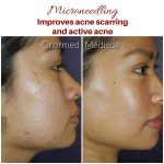 Reveal Radiant Skin:The Astonishing Benefits of Micro Needling benefits of micro needling