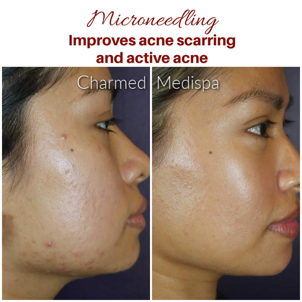 benefits of micro needling