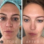 The Beauty Secrets, 7 Incredible Benefits of Microneedling benefits of microneedling