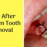 Wisdom Teeth Woes, Amazing Benefits of Removing Them Today benefits of removing wisdom teeth