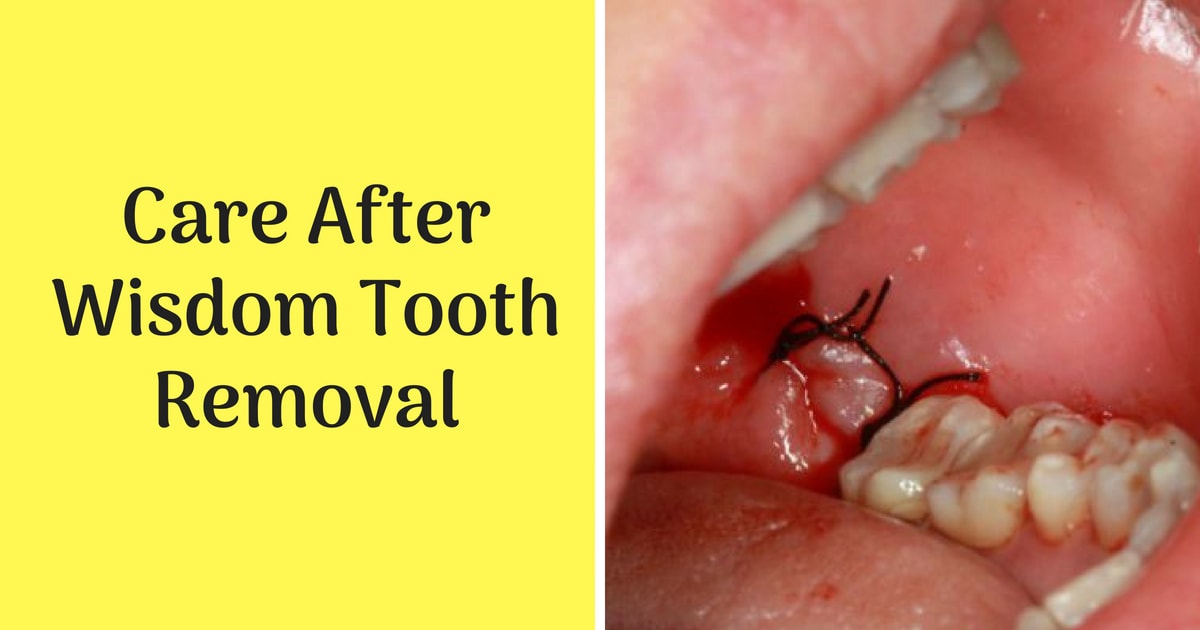 benefits of removing wisdom teeth