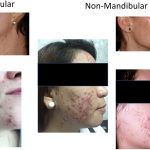 The Hidden Wonders, Astonishing Benefits of Spironolactone benefits of spironolactone