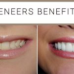 The Perfect Smile, Incredible Benefits of Veneers benefits of veneers