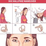 Dix Hallpike Maneuver Diagnosis and Treatment dix hallpike
