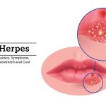The Herpes Virus, Its Causes, Symptoms, and Treatment herpes virus