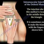 Mastering Intramuscular Injections, Painless and Effective Administration intramuscular injection