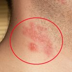 Mysteries of Nagin Disease, A Closer Look at its Symptoms, Causes, and Treatments nagin disease