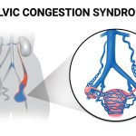 Pelvic Congestion Syndrome Causes, Symptoms, and Treatment pelvic congestion syndrome