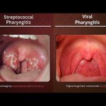 Sore Throat Solutions, Conquering Pharyngitis for Good pharyngitis