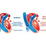 Right Sided Heart Failure Causes, Symptoms, and Treatment right sided heart failure