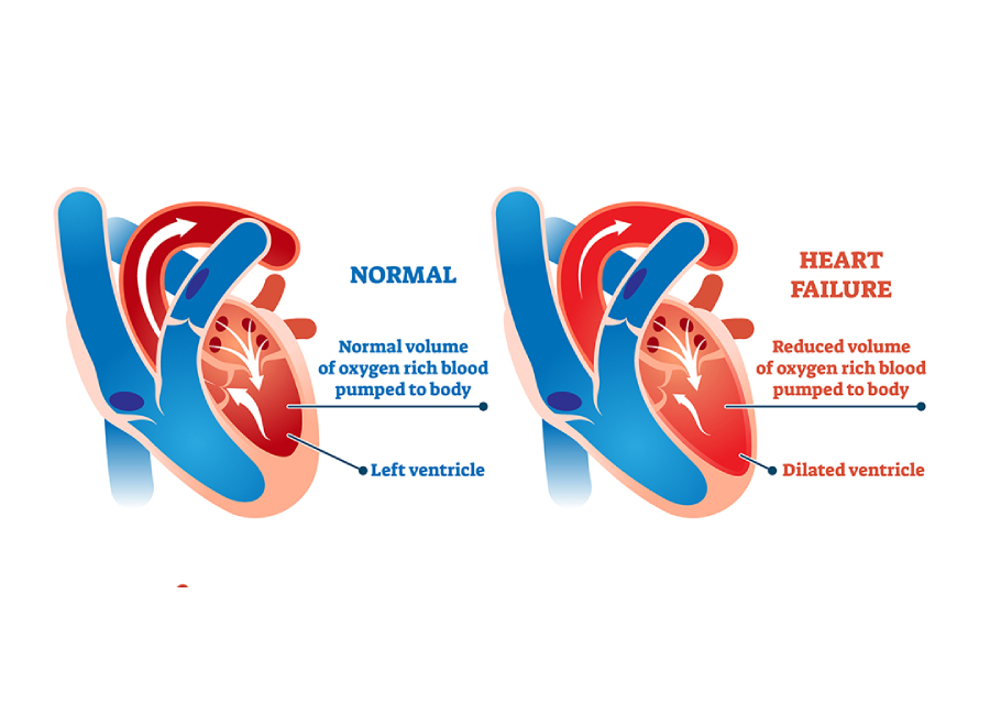 right sided heart failure