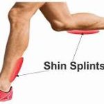 Shin Splints: Causes, Symptoms, Prevention, and Treatment shin splints