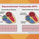 Effective SVT Treatment Options A Comprehensive Guide svt treatment