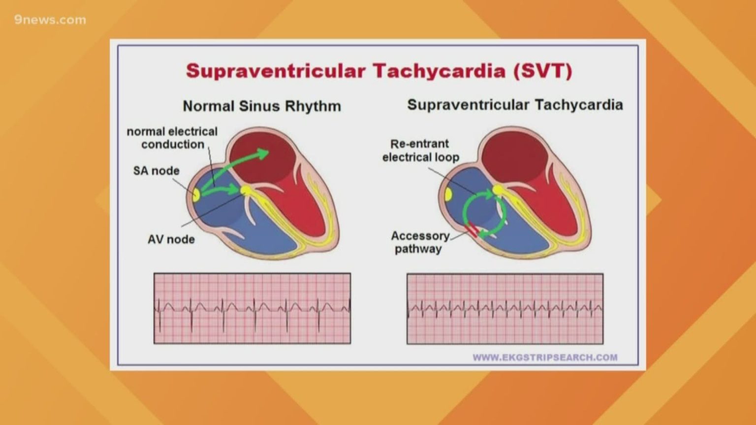 Effective SVT Treatment Options A Comprehensive Guide