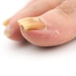 Why Do You Have Thick Toenails Causes, Treatment, and Prevention thick toenails