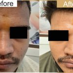 Revealing Radiance, The Transformative Benefit of Chemical Peel benefit of chemical peel