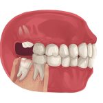 Beyond the Pain, Comprehensive Benefits of Removing Wisdom Teeth benefit of removing wisdom teeth