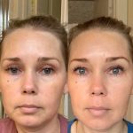 The Beauty Secrets, Incredible Benefits of Tretinoin benefit of tretinoin