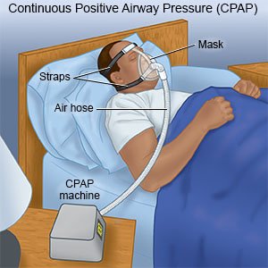 benefits of a cpap machine