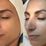 Rejuvenate Your Skin, Incredible Benefits of Cryo Facial benefits of cryo facial