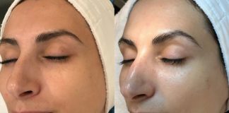 benefits of cryo facial