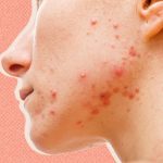 The Fountain of Youth, Incredible Benefits of Estrogen for Your Skin benefits of estrogen for skin