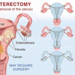 The Hidden Gems, 5 Incredible Benefits of Partial Hysterectomy benefits of partial hysterectomy