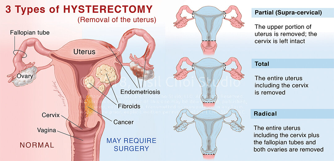 benefits of partial hysterectomy