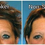 The Benefits of Quitting Smoking on Skin, a Radiant Transformation benefits of quitting smoking on skin