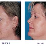 The Beauty Secrets, Incredible Benefits of Retin-A benefits of retin a
