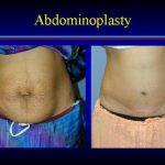 Sculpting Confidence, Remarkable Benefits of Tummy Tuck Surgery benefits of tummy tuck
