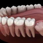 Wisdom Teeth Removal, a World of Benefits benefits of wisdom teeth removal