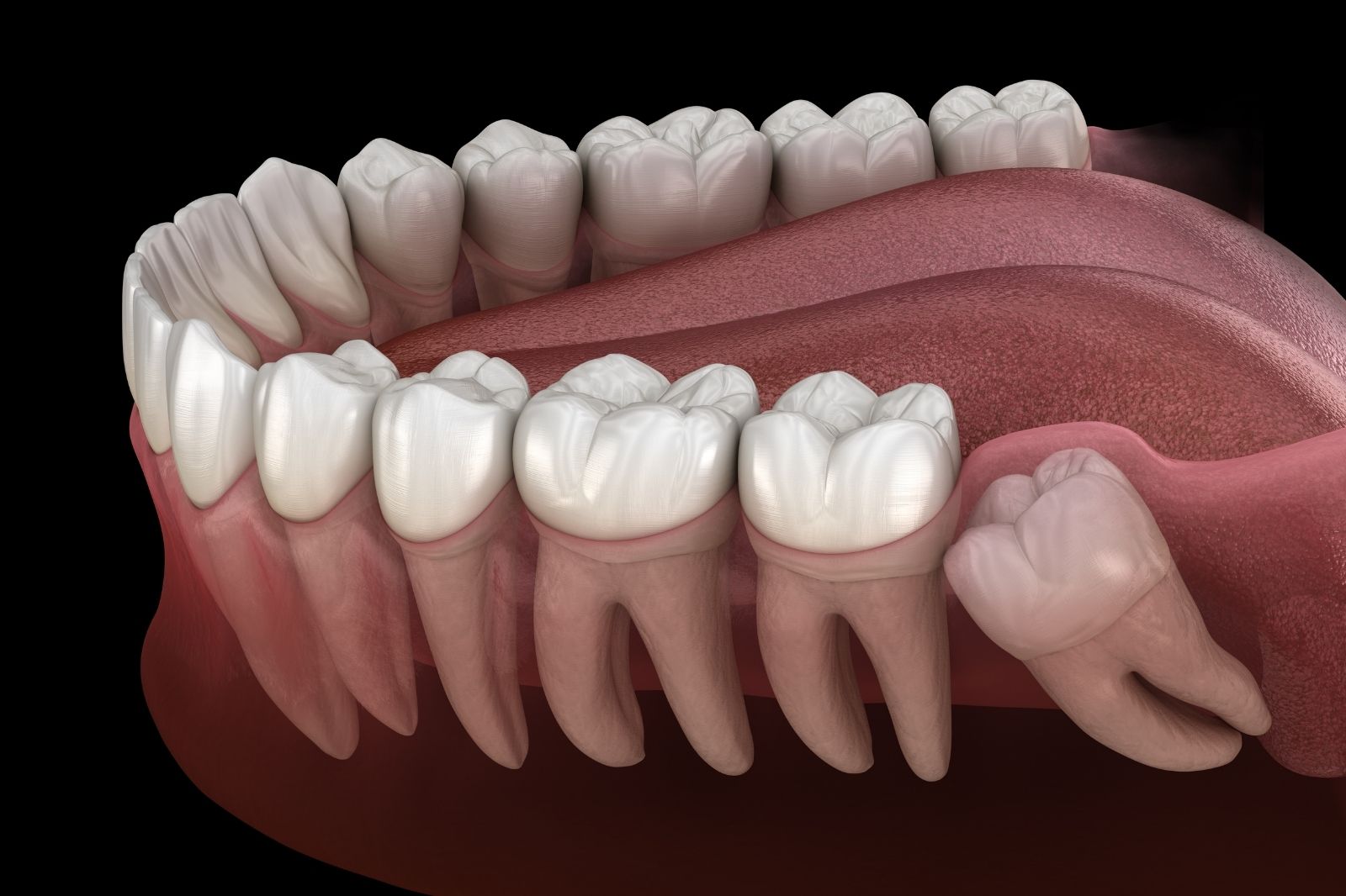 benefits of wisdom teeth removal