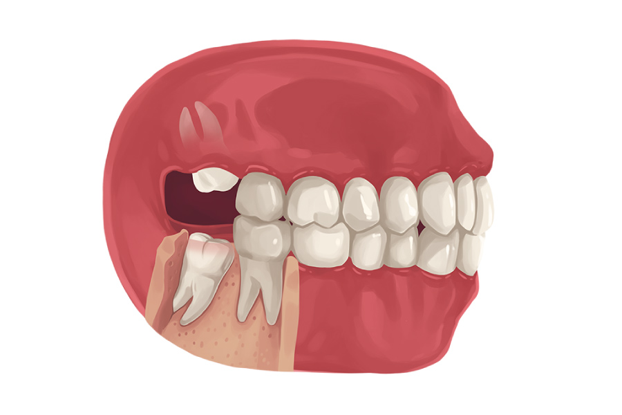 benefits of wisdom tooth removal