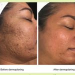 Radiance, The Long-Term Wonders of Dermaplaning long term benefits of dermaplaning