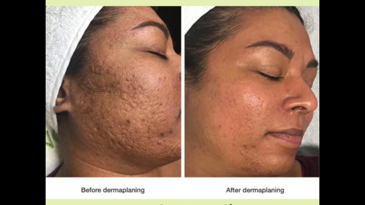 long term benefits of dermaplaning