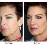From Smoke to Glow, Skin Benefits of Quitting Smoking skin benefits of quitting smoking