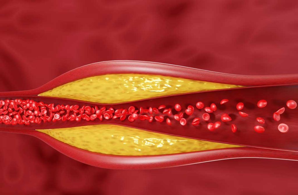 Cholesterol Fluctuations