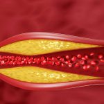 Cholesterol Fluctuations A Potential Early Sign of Dementia Risk in Older Adults Cholesterol Fluctuations